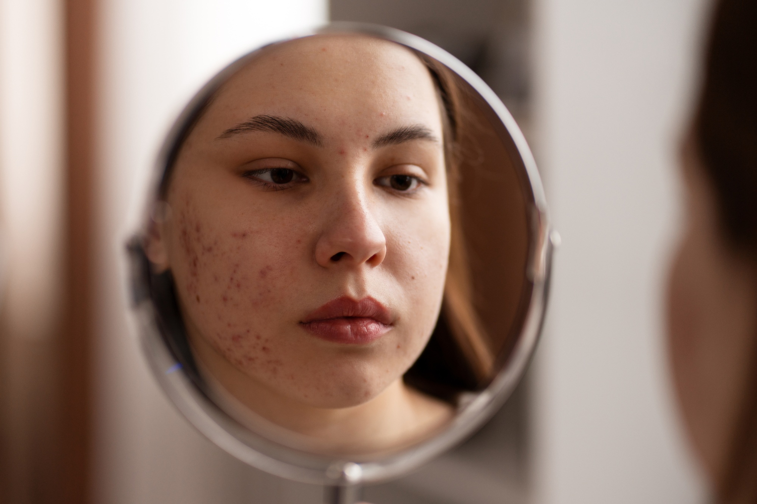 acne-scar