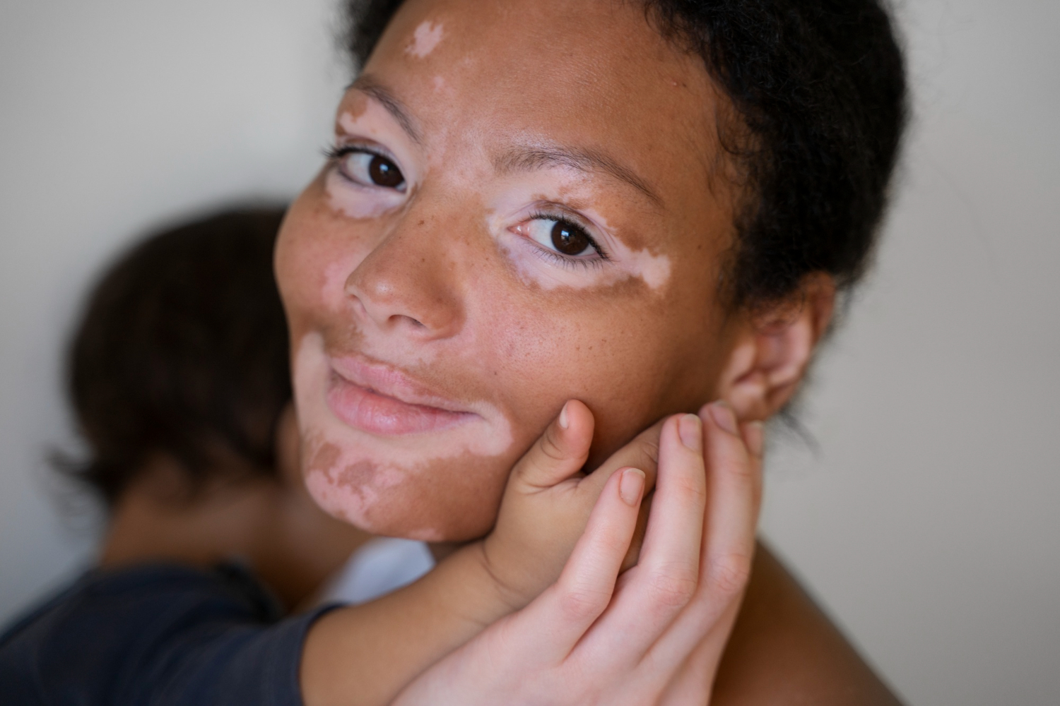 pigmentation