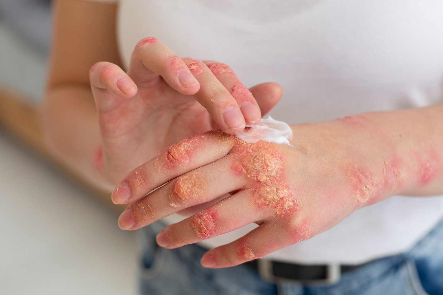 skin-infections