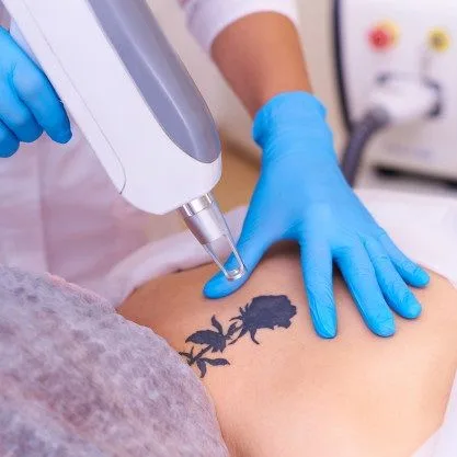 tattoo-removal