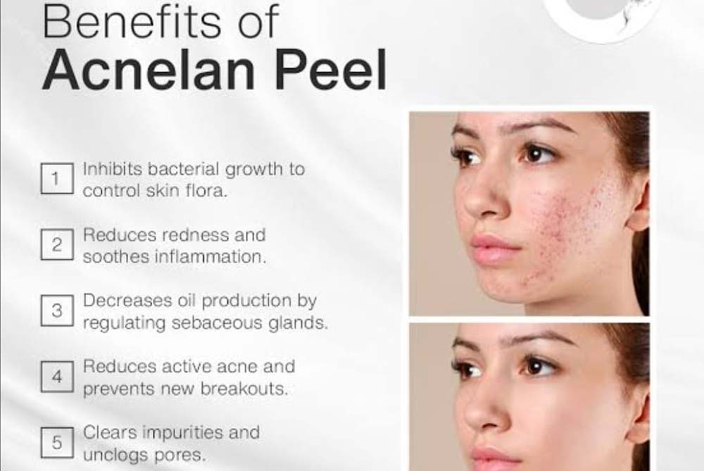 acnelan-peel-header
