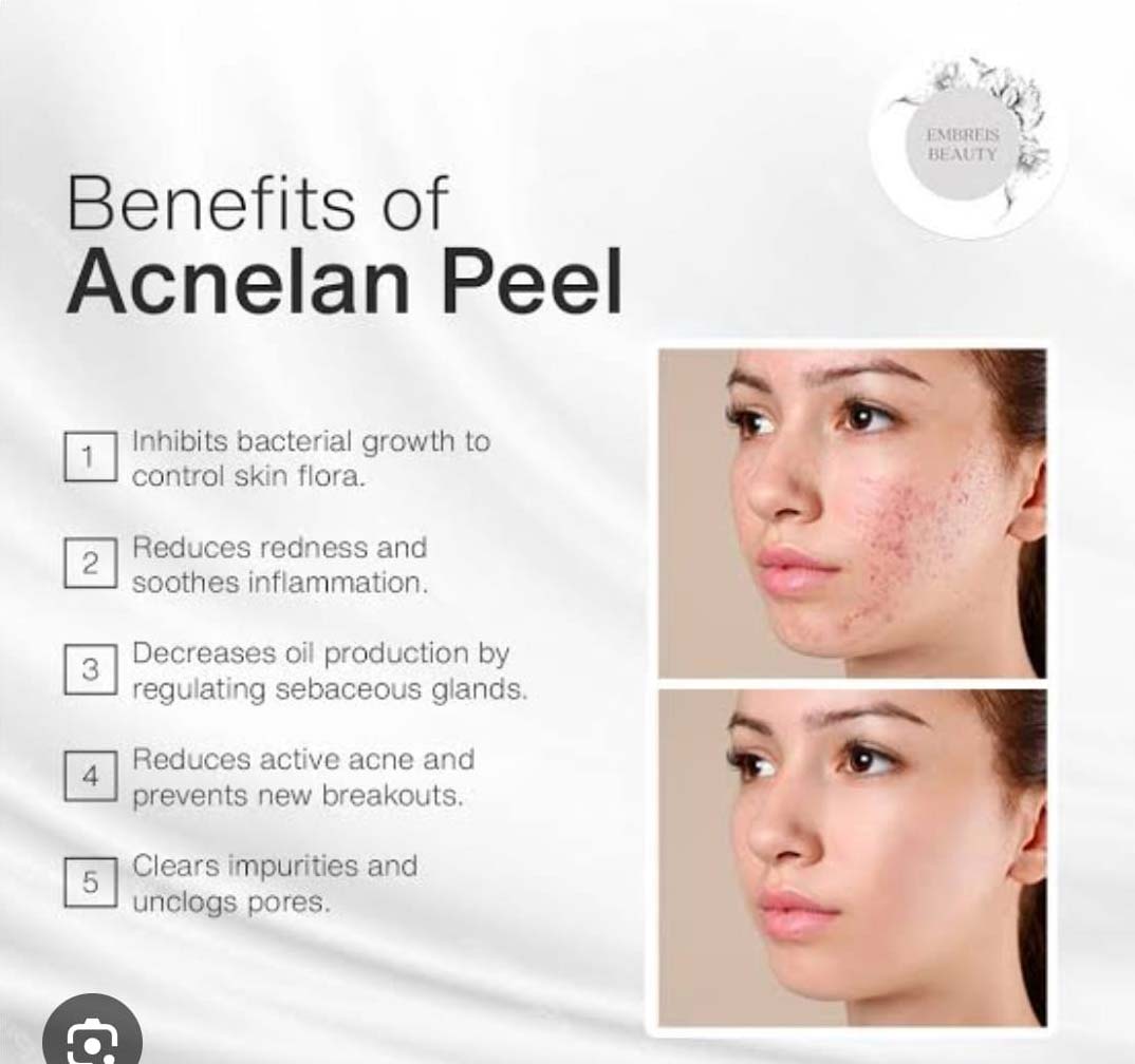 acnelan-peel