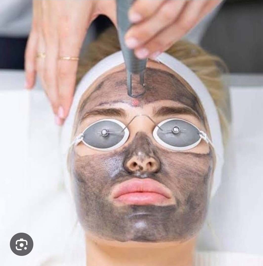 carbon-peel