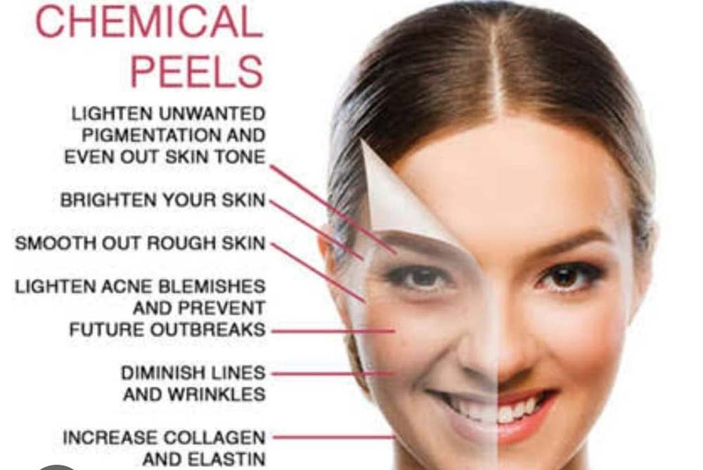 chemical-peel-header