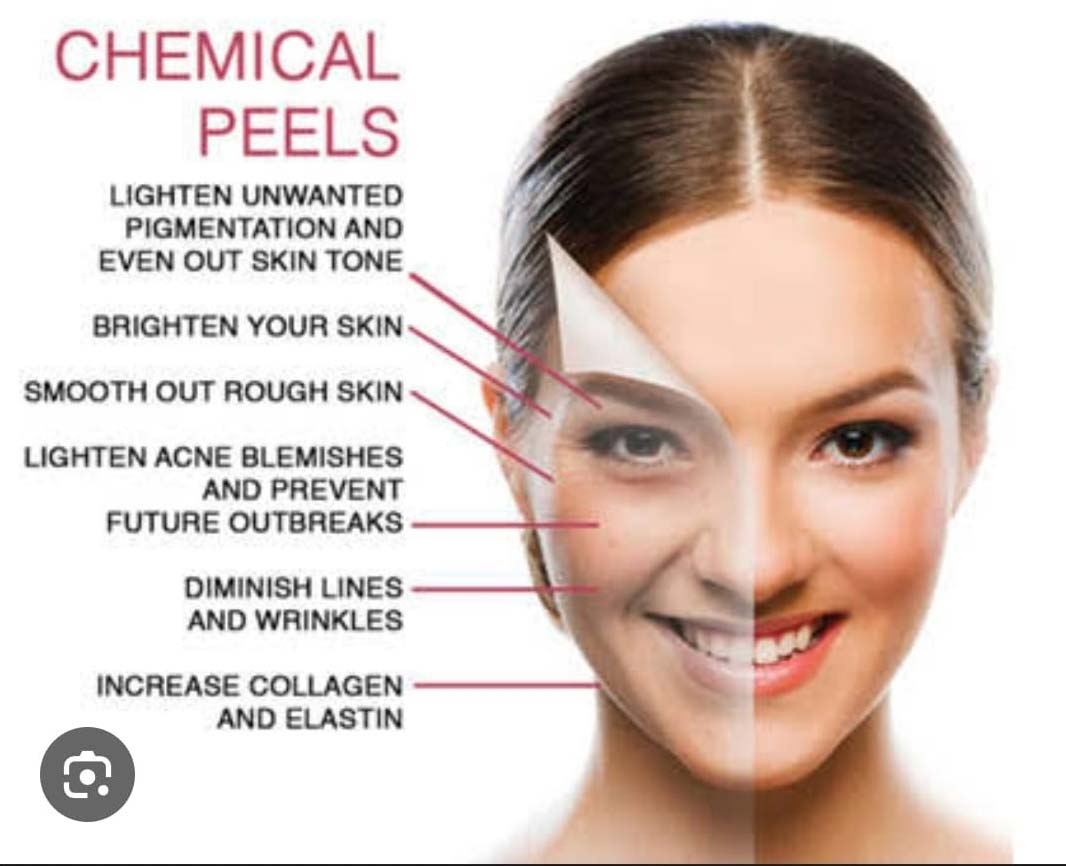 chemical-peel