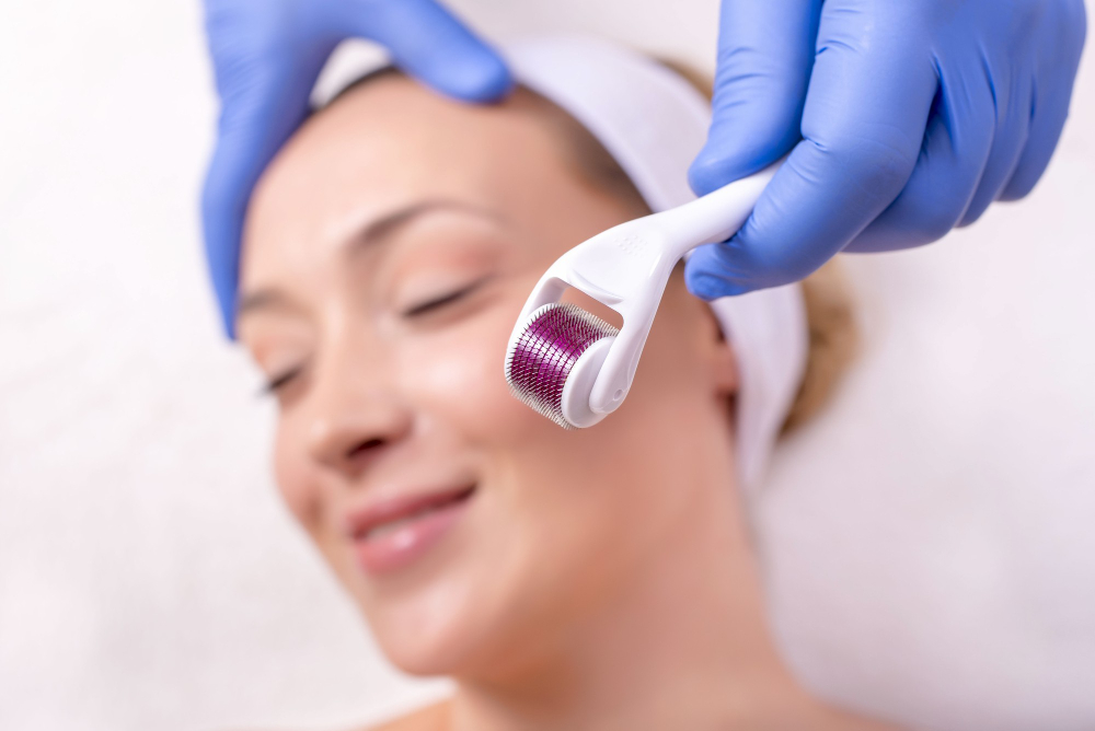 Dermaroller therapy