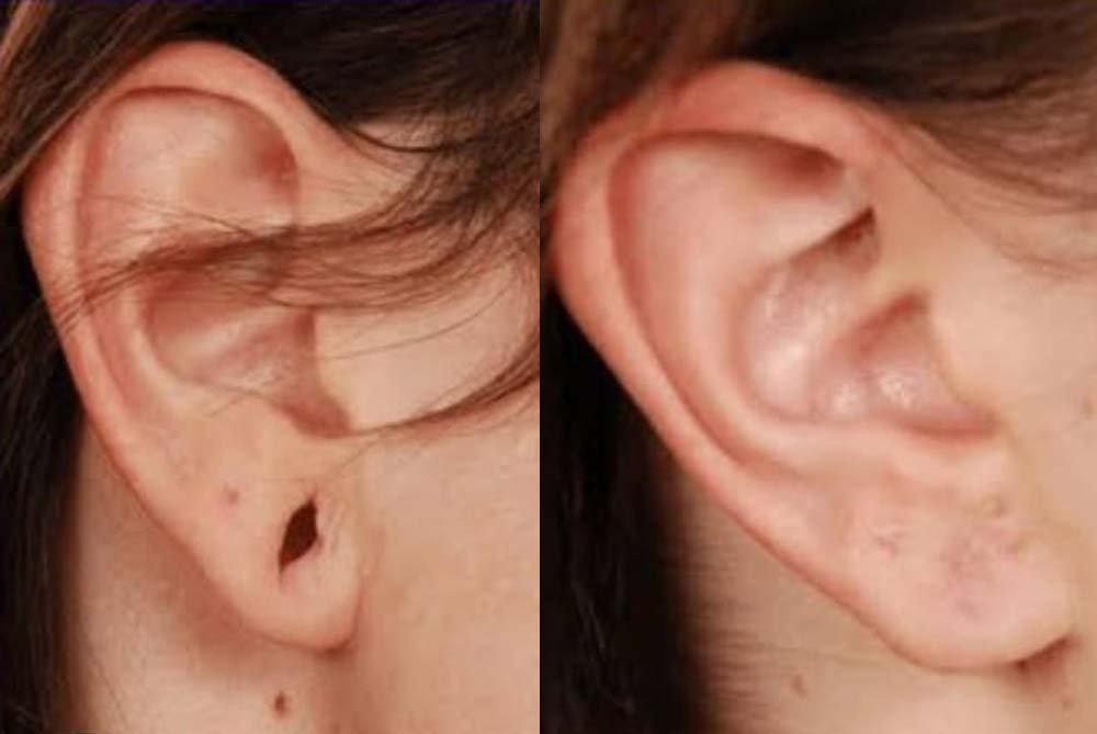 Ear Lobe Repair