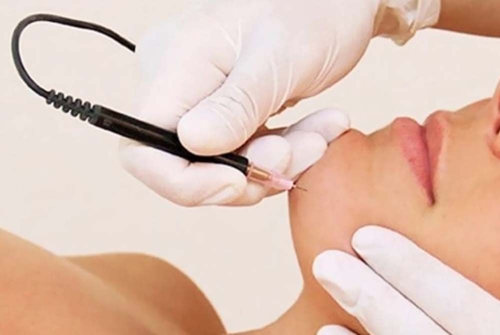 Electrolysis