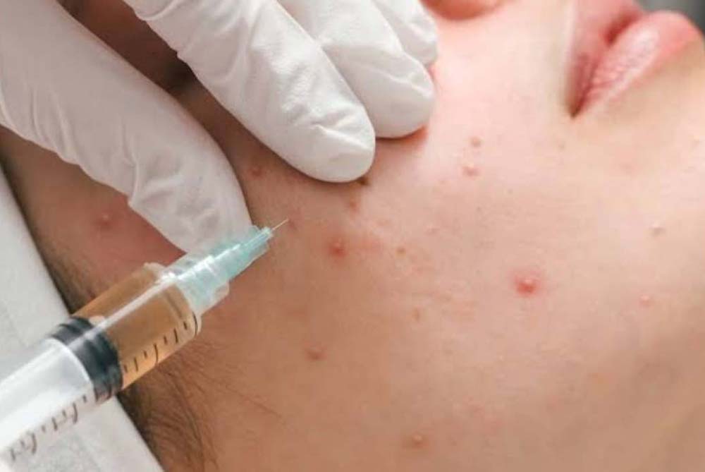 intralesional-acne-injection-header
