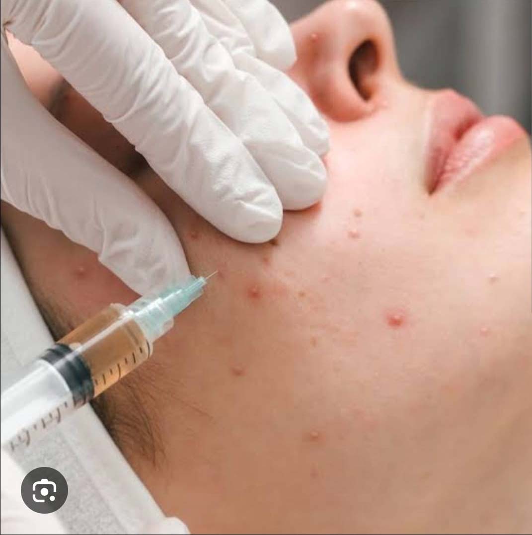 intralesional-acne-injection