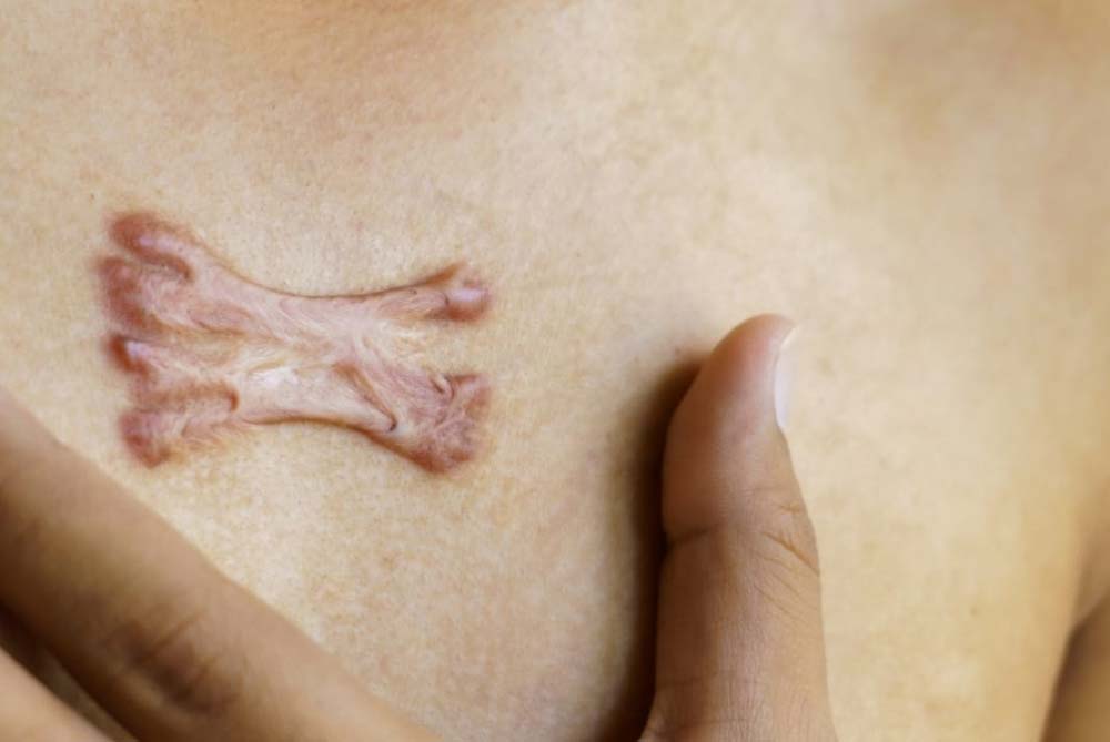Keloid Treatment