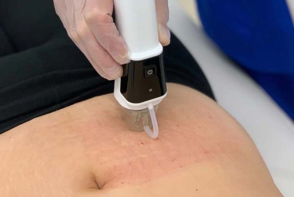 mnrf-stretch-mark-header