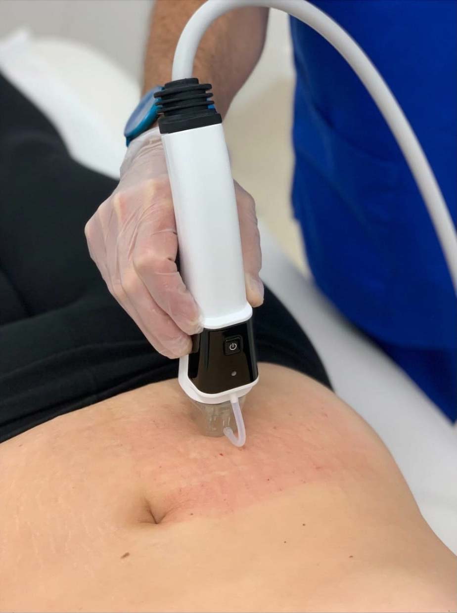 mnrf-stretch-mark