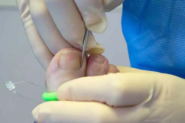 Nail Surgery