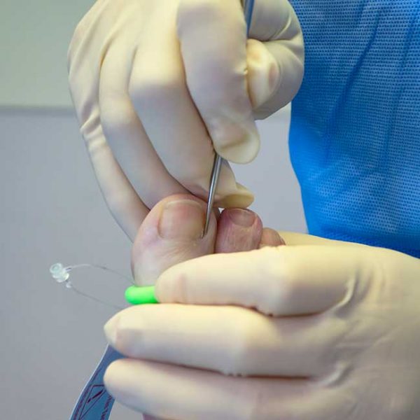 Nail Surgery