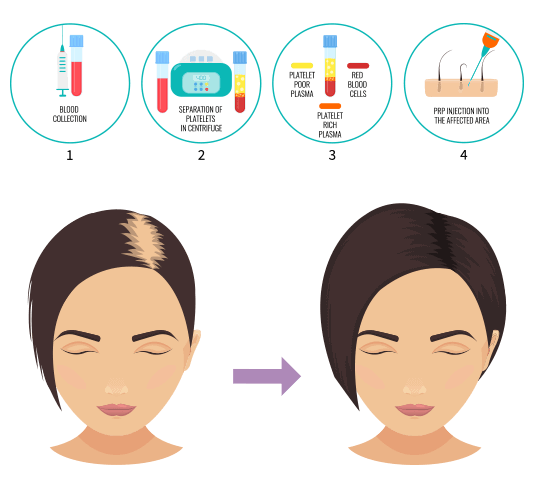 PRP for Hair Loss Treatment