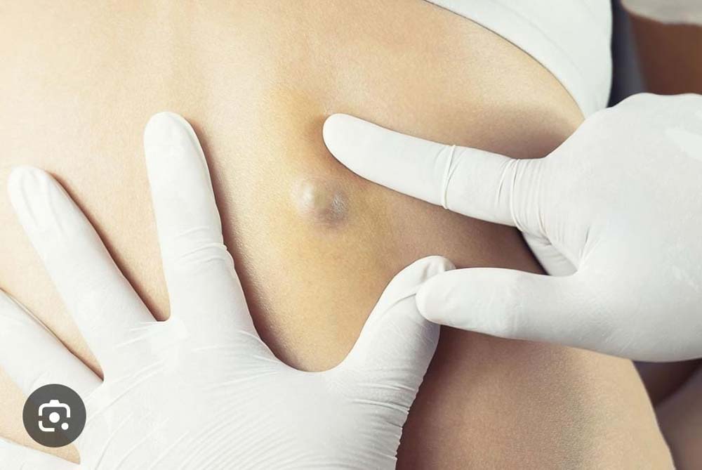Sebaceous Cyst Removal