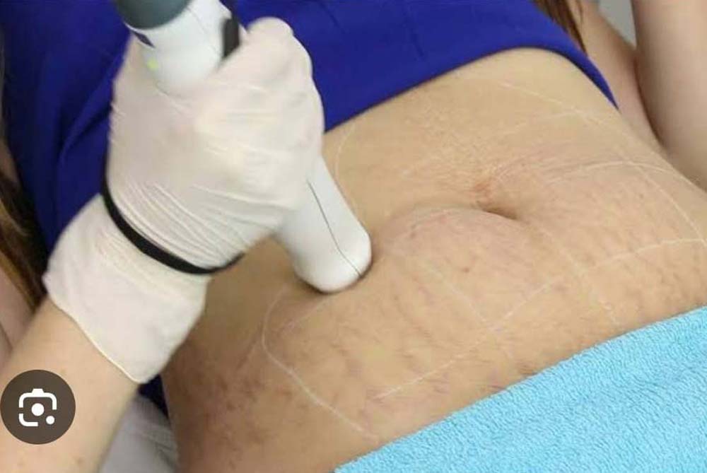 stretch-mark-co2-laser-header