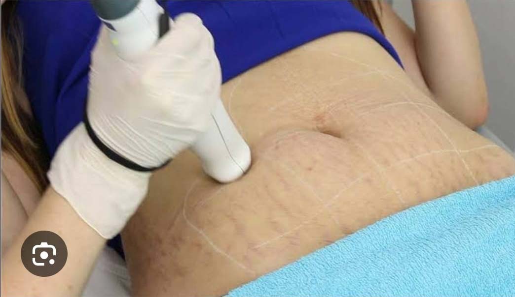 stretch-mark-co2-laser