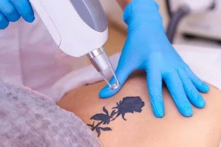 Tattoo Removal